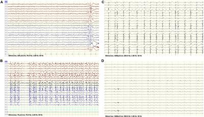 FARS2 Mutations: More Than Two Phenotypes? A Case Report